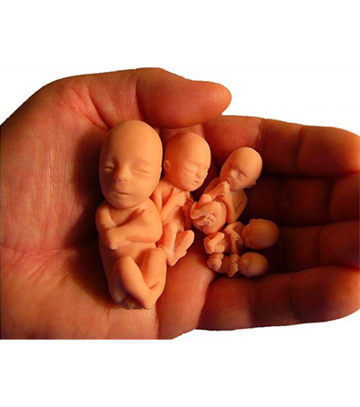 Düşük (abortus) nedir? Önlenebilir mi?