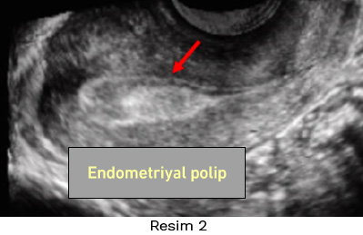 Endometriyal polip