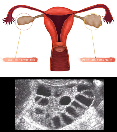 Polikistik over sendromu (PCOS)